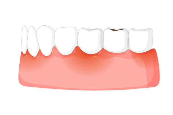 periodontitis