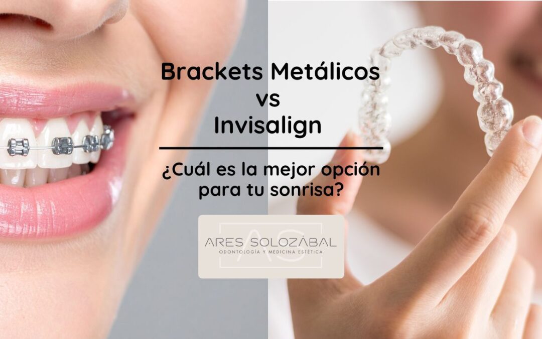 Brackets Metálicos vs Invisalign: ¿Cuál es la mejor opción para tu sonrisa?