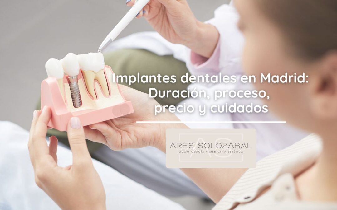 Implantes dentales en Madrid: Duración, proceso, precio y cuidados