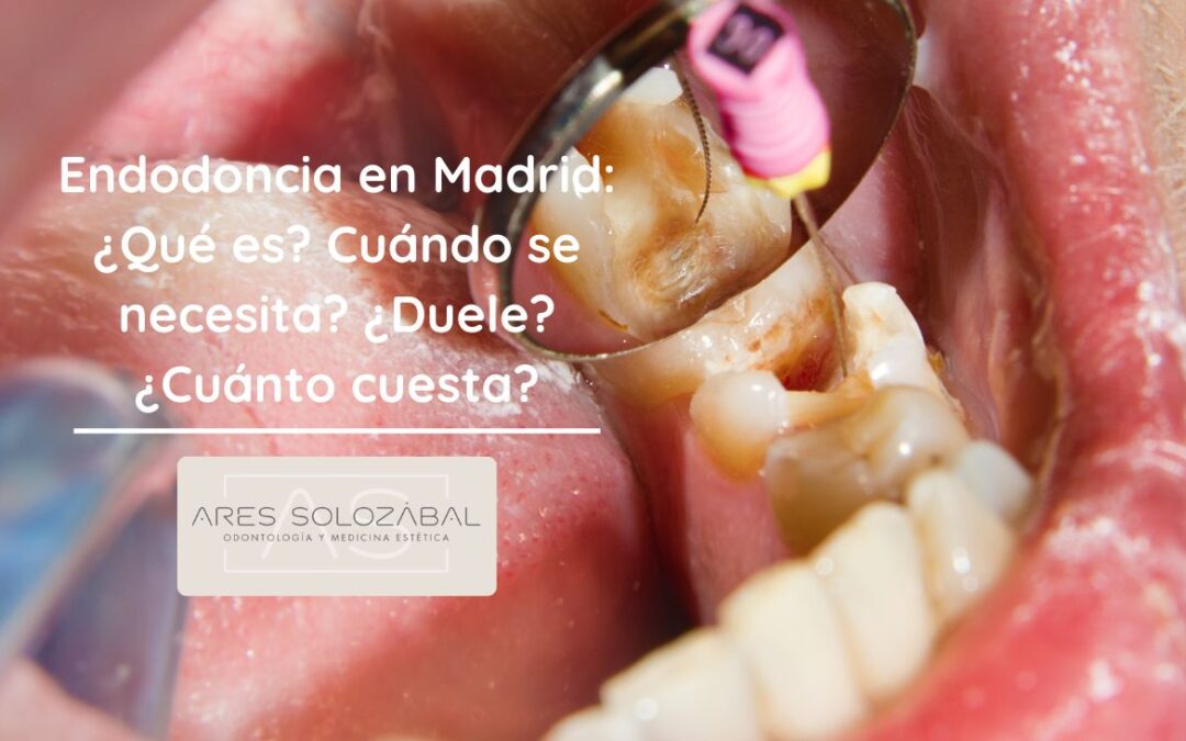Endodoncia en Madrid: ¿Qué es? ¿Cuándo se necesita? ¿Duele? y ¿Cuánto cuesta?