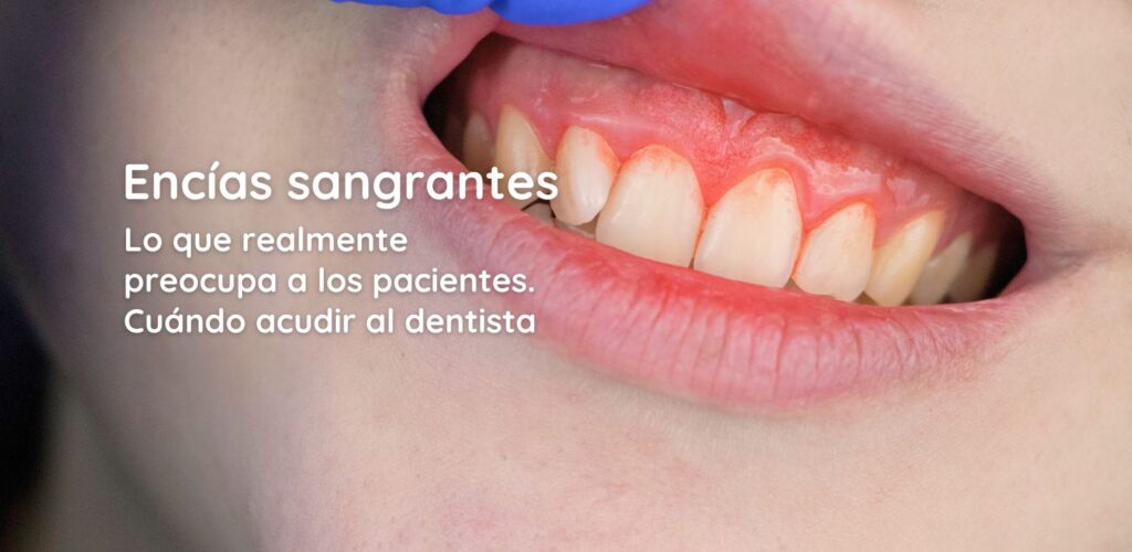 encías sangrantes: cuándo acudir al dentista
