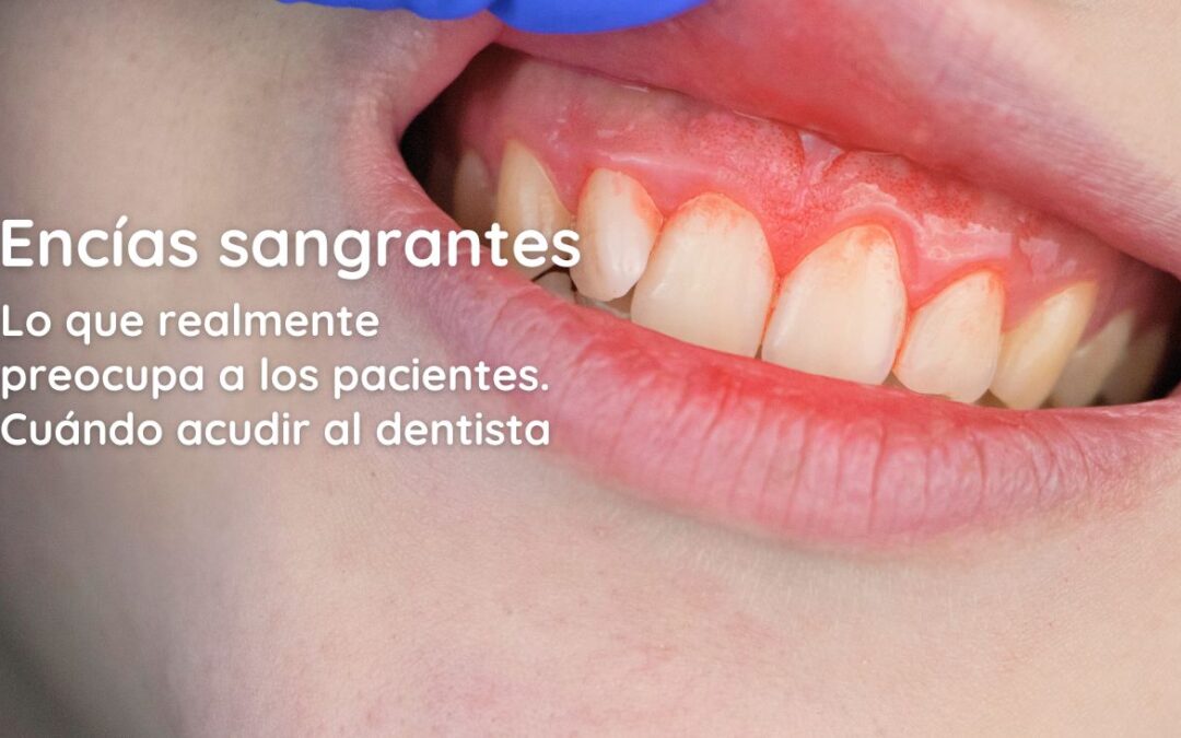 Encías sangrantes: lo que realmente preocupa a los pacientes y cuándo acudir al dentista