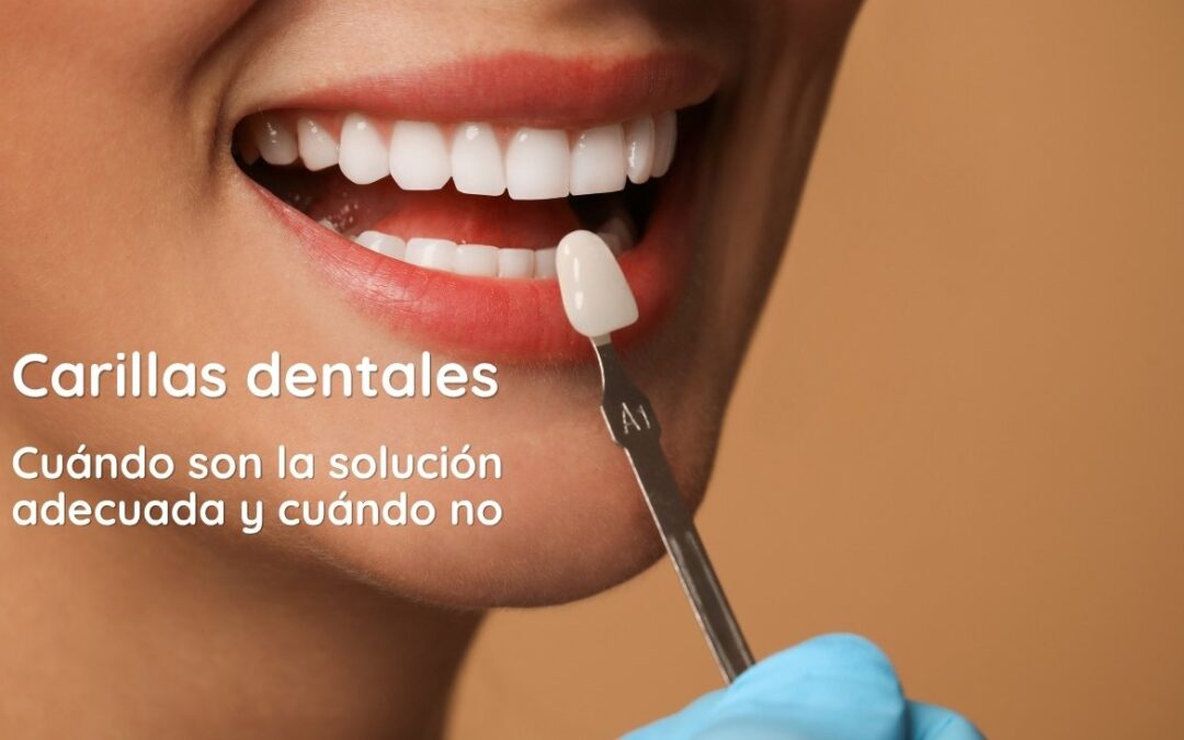 Carillas dentales: cuándo son la solución adecuada y cuándo no
